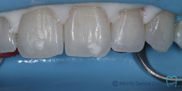 ICON A no-drill, minimally invasive resin infiltration technique